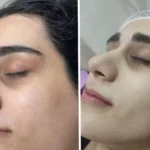 خدمات مراقبت پوستی در رشت | پاکسازی پوست در رشت